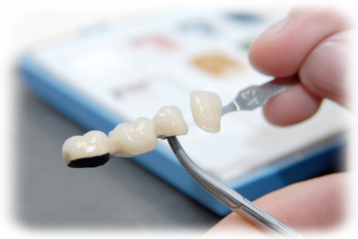 Zahnbrücke mit drei Zähnen