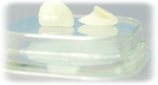 dünne weisse Veneers aus Keramik